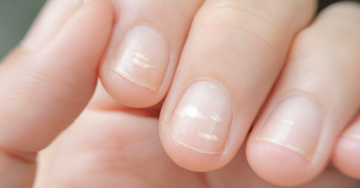 Fingernägel & Gesundheit - sind Rillen, brüchige Nägel, weiße Flecken & Co Mangelzeichen?